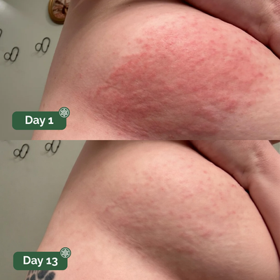 UNDERCARE™ Relief Cream