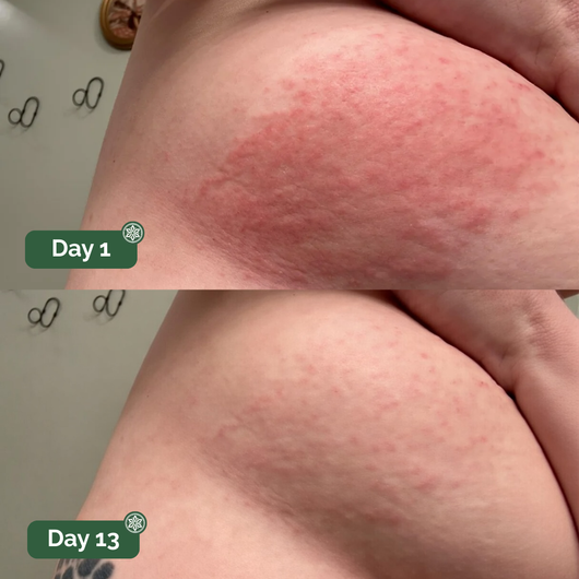 UNDERCARE™ Relief Cream