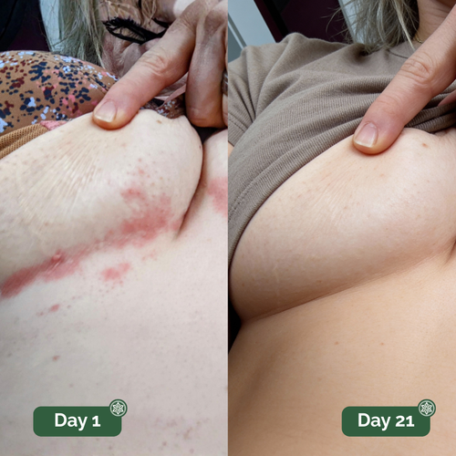 UNDERCARE™ Relief Cream